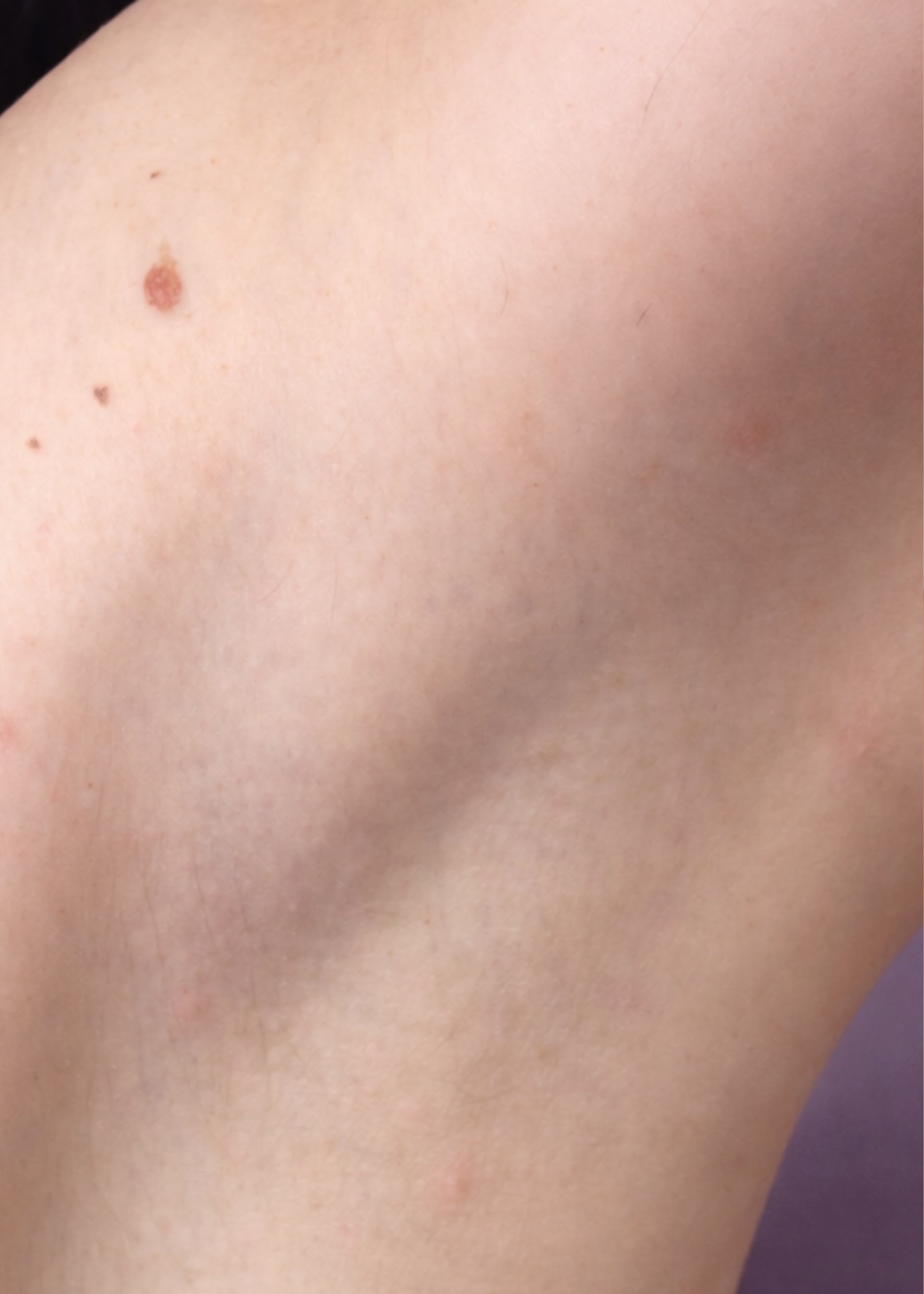 Aisselles après traitement