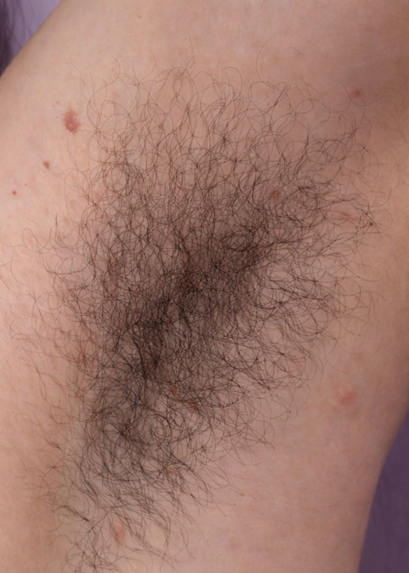 Aisselles avant traitement